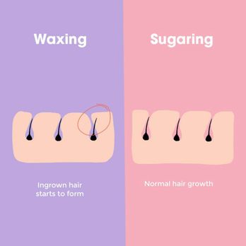 Sugaring NYC - Tyler - Sugaring Near Me - Tyler, Texas Sugaring NYC - Tyler - Sugaring Near Me - Tyler, Texas