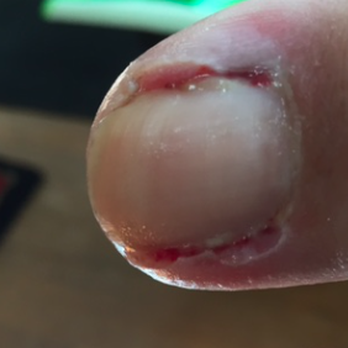 Salon D'elegance - My toe after one of the multiple toenail  procedures I have needed due to coming to this TERRIBLE salon. PLEASE don't come here.... - Nail Salons Near Me - Wayland, Massachusetts