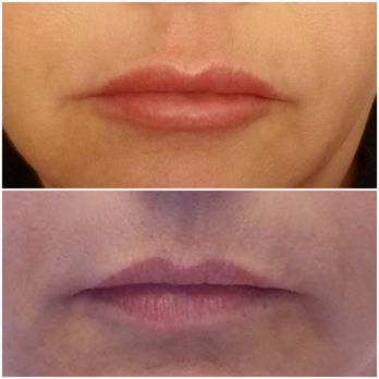 Blue Illusion Beauty - Very happy with the results. - Cosmetic Surgeons Near Me - San Diego, California Blue Illusion Beauty - Very happy with the results. - Cosmetic Surgeons Near Me - San Diego, California