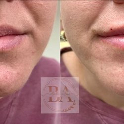 Restylane lip fillers