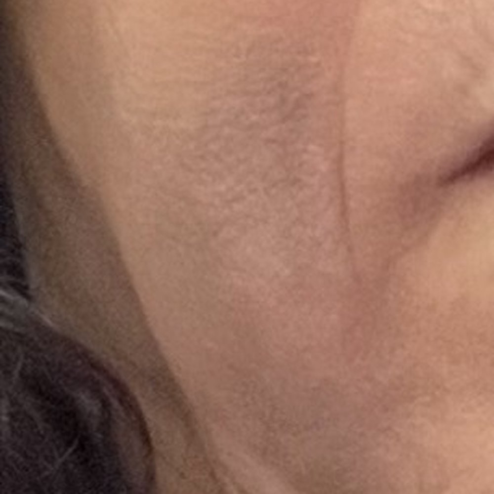 4Ever Young Med Spa & Wellness Center - Ridgewood - Big hematoma following with bruises. - IV Hydration Near Me - Ridgewood, New Jersey 4Ever Young Med Spa & Wellness Center - Ridgewood - Big hematoma following with bruises. - IV Hydration Near Me - Ridgewood, New Jersey