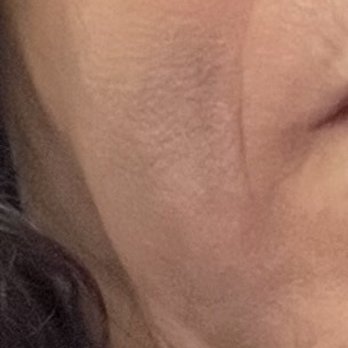 4Ever Young Anti Aging Solutions - Big hematoma following with bruises. - IV Hydration Near Me - Ridgewood, New Jersey 4Ever Young Anti Aging Solutions - Big hematoma following with bruises. - IV Hydration Near Me - Ridgewood, New Jersey