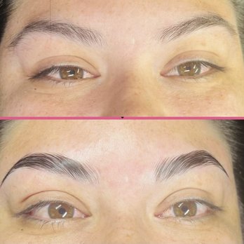 Lymphatic Aesthetics - Before and after - Body Contouring Near Me - San Diego, California