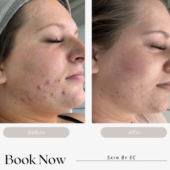 Skin By EC - Acne Bootcamp Client - Skin Care Near Me - Davie, Florida Skin By EC - Acne Bootcamp Client - Skin Care Near Me - Davie, Florida