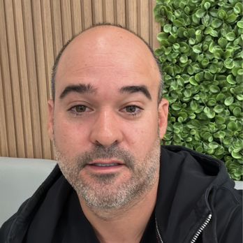 TJ Hair System - Implant day - Hair Loss Centers Near Me - Tijuana, BCN TJ Hair System - Implant day - Hair Loss Centers Near Me - Tijuana, BCN