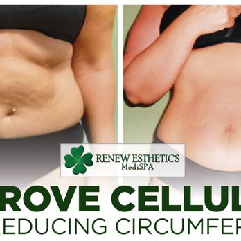 Renew Esthetics MediSPA - Amazing results #BodyTreatments * FREE INITIAL Call us : (718)2040458 CONSULTATION * http://ow.ly/3OiP309YZge - Laser Hair Removal Near Me - Queens, New York Renew Esthetics MediSPA - Amazing results #BodyTreatments * FREE INITIAL Call us : (718)2040458 CONSULTATION * http://ow.ly/3OiP309YZge - Laser Hair Removal Near Me - Queens, New York