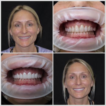 Orange Premier Dental - Before and after veneers - Cosmetic Dentists Near Me - Orange, California Orange Premier Dental - Before and after veneers - Cosmetic Dentists Near Me - Orange, California