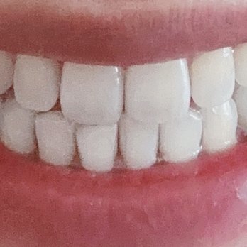 Goodman Orthodontics - Manhattan - After treatment - Orthodontists Near Me - New York, New York