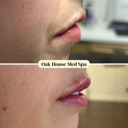 Oak House Med Spa and Wellness Center - Lip filler with Restylane Kysse