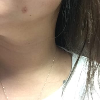 J Beauty Clinic - Burn mark :( I really like the professionalism of this place. But I won't go back due to this and the level of pain. - Cosmetics & Beauty Supply Near Me - Honolulu, Hawaii J Beauty Clinic - Burn mark :( I really like the professionalism of this place. But I won't go back due to this and the level of pain. - Cosmetics & Beauty Supply Near Me - Honolulu, Hawaii