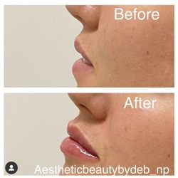 Royalty Care Med Spa - 1 syringe of Juvederm! We have an amazing offer 954-526-1696