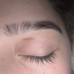 Scar on eyelid