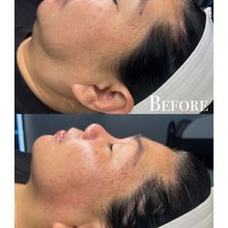 Luna Tropical - Anti aging rf facial