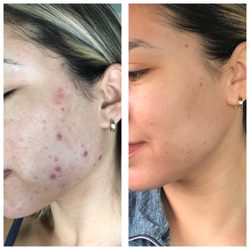 Secret Skin Bar - Clear Skin is possible! Book your in person or virtual acne consult and treatment!