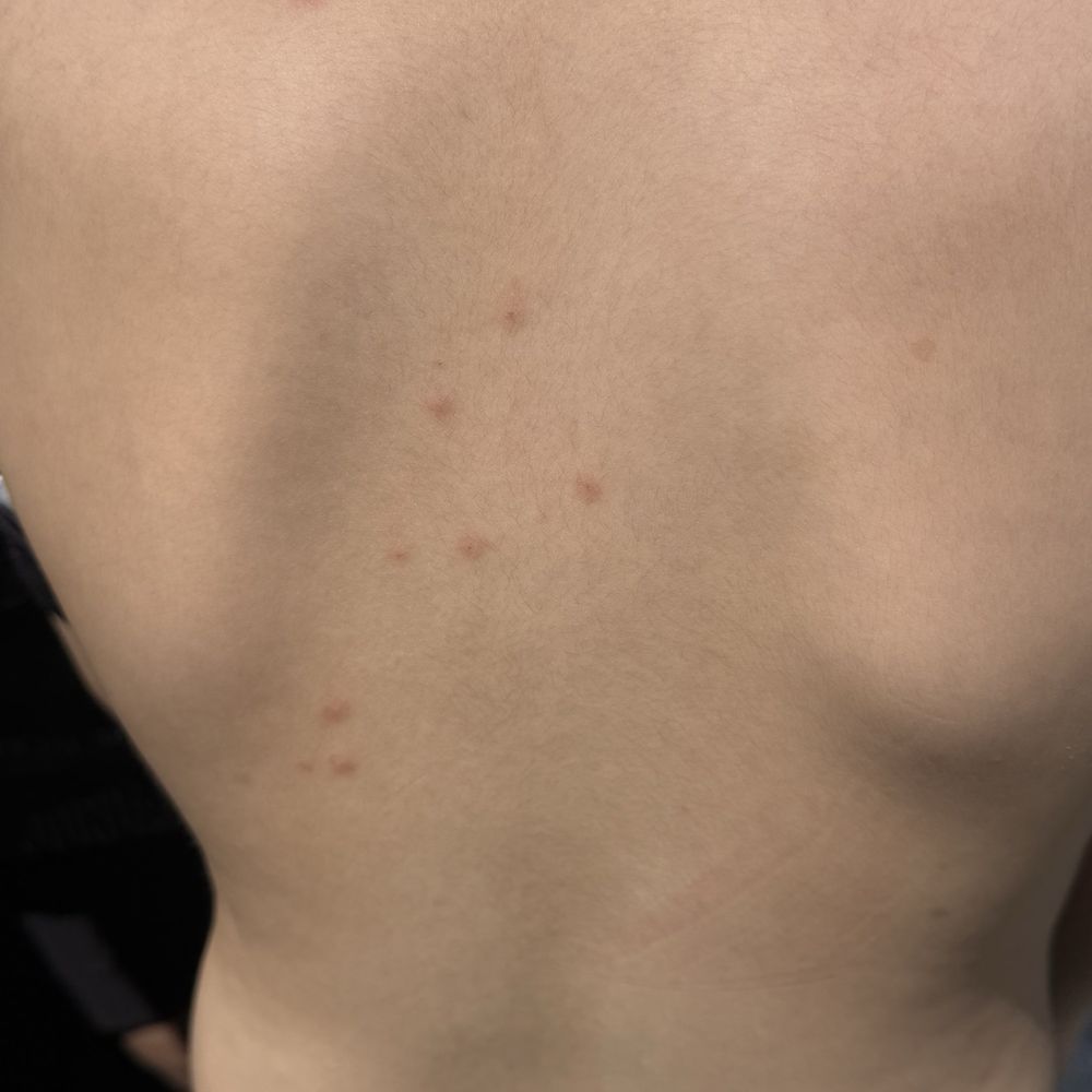 SpringHill Suites by Marriott Newark Fremont - Bed bug's bite - Hotels Near Me - Newark, California