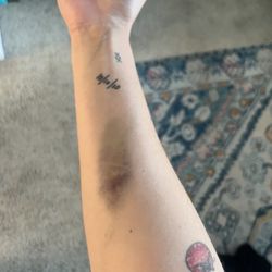 Labcorp - My arm one week after getting blood drawn
