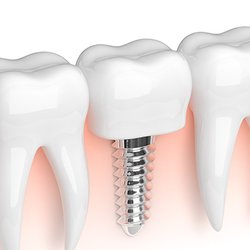 Chase Judd, DDS - Dental Implants
