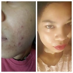 White Rose Skin Care - (L B4 seeing Jenny (R) 8 months reg visits. Same camera. Dif lighting, but I've taken photos w/same lighting that caught blemishishs/redness