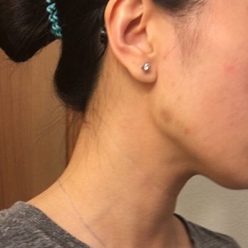 David C. Mabrie, MD - Bruises, bled and obvious shot marks from Botox shot in the jaw area. First time getting bruises and bled! - Cosmetic Surgeons Near Me - San Francisco, California