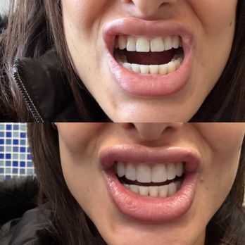 Smile Cafe Dental Spa - Before and after resin veneers - Cosmetic Dentists Near Me - New York, New York Smile Cafe Dental Spa - Before and after resin veneers - Cosmetic Dentists Near Me - New York, New York
