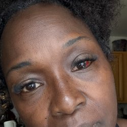 Pearlbrows & Lash Studio - Comparisons to both eyes. Left eye is blood shot, swollen, heavy with discoloration around it.