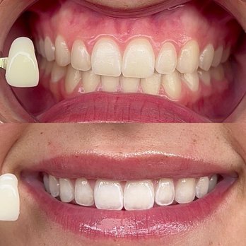 The Coco Blanc Teeth Whitening - Teeth Whitening Near Me - Costa Mesa, California The Coco Blanc Teeth Whitening - Teeth Whitening Near Me - Costa Mesa, California