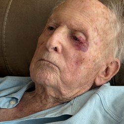 Florida Eye Associates - Right after procedure