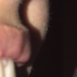You can see the bump alot from the side, lips after (not a good job)