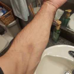 Biomat USA - Look at my veins... how the hell does this happen??