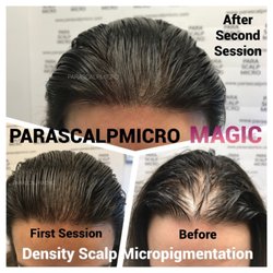 Parascalpmicro - Magically fix Female Pattern Baldness, Hair Density Scalp Micropigmentation,  Nano Hair Follicle Tattoo.New York City Best Artist training