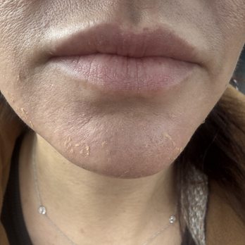 Biorevive Jersey City - peeling in 3rd day - Medical Spas Near Me - Jersey City, New Jersey Biorevive Jersey City - peeling in 3rd day - Medical Spas Near Me - Jersey City, New Jersey