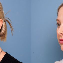Landon Pryor, MD, FACS - 36 year old female before and 6 weeks after myellevate with liposuction to neck.