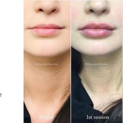 Sparrow MD - Natural Lip Enhancement