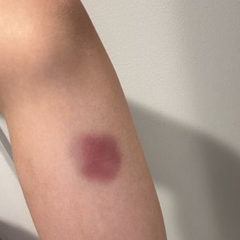 Nature’s Edge Spa - Hot stone bruise - Massage Near Me - San Francisco, California Nature’s Edge Spa - Hot stone bruise - Massage Near Me - San Francisco, California