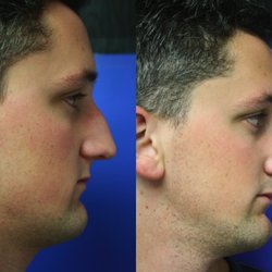 FacebyDrH - Male Rhinoplasty with hump reduction