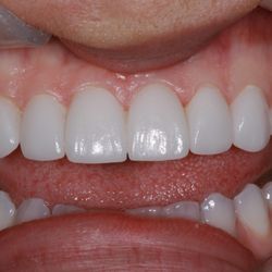 Anthony Bordas ,DDS - Beautiful Veneer Case
