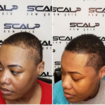 Scalp Hairlines International - Adding density - Hair Loss Centers Near Me - Solvay, New York Scalp Hairlines International - Adding density - Hair Loss Centers Near Me - Solvay, New York