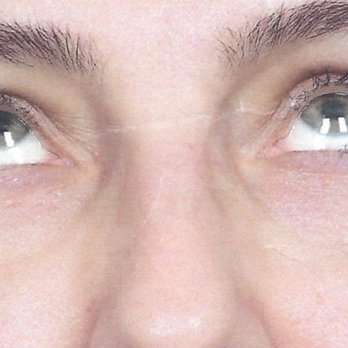 Marina Plastic Surgery - Under eye after - Medical Spas Near Me - Los Angeles, California Marina Plastic Surgery - Under eye after - Medical Spas Near Me - Los Angeles, California