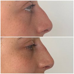 Beauty Culture Med Spa - Filler!