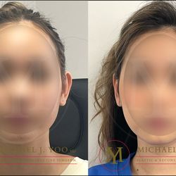 Michael J Yoo, MD - Unilateral (Left) Otoplasty for Asymmetric Ears - Dr. Michael J. Yoo, MD - Double Board Certified Plastic Surgeon