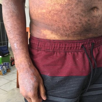Allergy and Immunology Center - My stomach and arms... - Allergists Near Me - Miami, Florida Allergy and Immunology Center - My stomach and arms... - Allergists Near Me - Miami, Florida