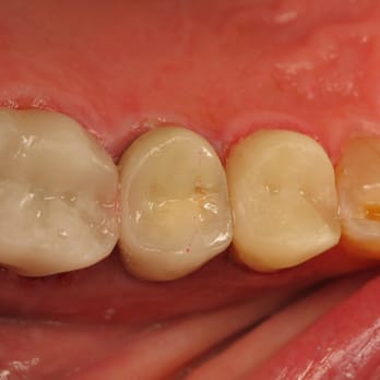 David W Epstein, DDS - All Silver replaced - Oral Surgeons Near Me - Novato, California