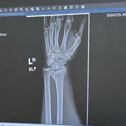 Shasta Orthopaedics - Shattered bone for reference!