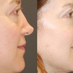 Kevin J Cross, MD - Cross Medical Group - Nose Reshaping (Rhinoplasty)