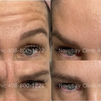 NovoBay Aesthetic Clinic - Medical Spas Near Me - Sunnyvale, California NovoBay Aesthetic Clinic - Medical Spas Near Me - Sunnyvale, California