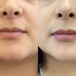 Before and After (healed, 6 weeks)