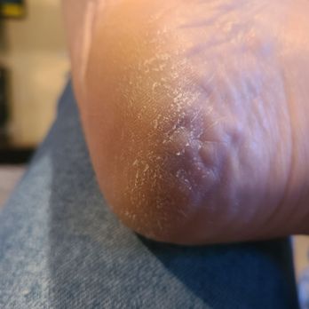 Rose's Nails & Spa - Dry heels that weren't hardly scrubbed. (I get frequent pedi's, it shouldn't look like this) - Nail Salons Near Me - Ukiah, California Rose's Nails & Spa - Dry heels that weren't hardly scrubbed. (I get frequent pedi's, it shouldn't look like this) - Nail Salons Near Me - Ukiah, California