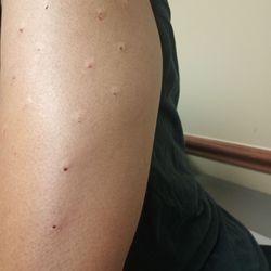 Allergy & ENT Associates - Day 1 Removal of tape