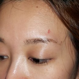 Burnt mark above my eyebrow Burnt mark above my eyebrow
