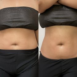 Sculpted - Stomach Treatment results after one session